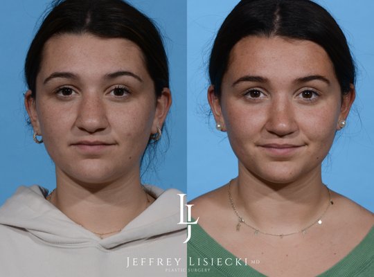 JEFFREY LISIECKI MD PLASTIC SURGERY - Updated June 2025 - 25 Photos