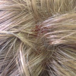 beauty  base - Burnt Scalp