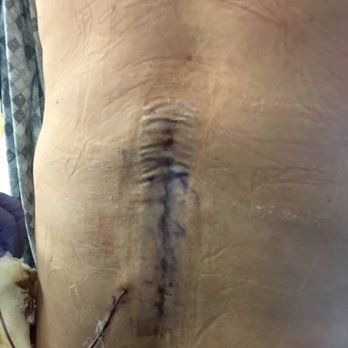 Michael J Martin, MD - Fusion back surgery - Orthopedists Near Me - Tacoma, Washington Michael J Martin, MD - Fusion back surgery - Orthopedists Near Me - Tacoma, Washington