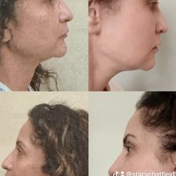 Skin & Vein Center - No change just alot of filler 5 months after lower fl/nl