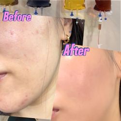 TROIAREUKE California - TROIPEEL Before After 1 session