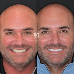 Smile Boutique Thousand Oaks - Dental Crowns at Smile Boutique