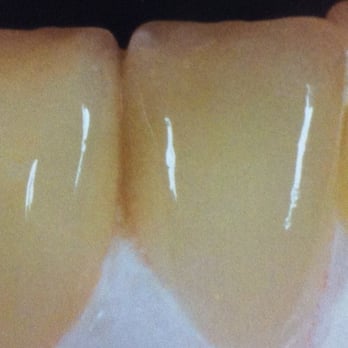 NYC Dental Center - veneers - General Dentistry Near Me - New York, New York NYC Dental Center - veneers - General Dentistry Near Me - New York, New York