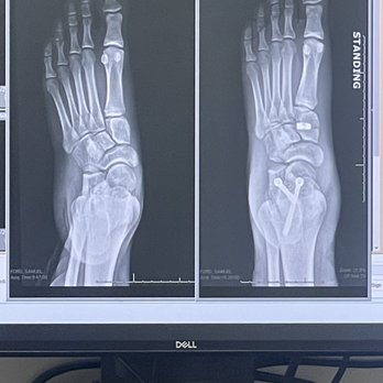 Ortho Carolina - Before and after - Podiatrists Near Me - Belmont, North Carolina Ortho Carolina - Before and after - Podiatrists Near Me - Belmont, North Carolina