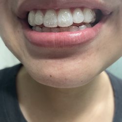 Upen J. Patel, DDS, MAGD, FICD, FPFA - Avorio Dental - KOR whitening trays in!