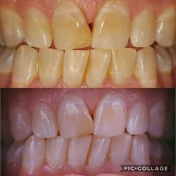 X&J Smiles Mobile Teeth Whitening - After 15 Minutes