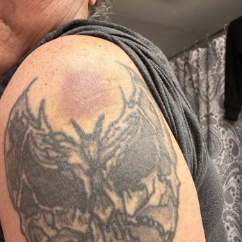 Quality Inn Near Amish Country - Arm bruised from steroid shot still have it - Hotels Near Me - Rushville, Indiana Quality Inn Near Amish Country - Arm bruised from steroid shot still have it - Hotels Near Me - Rushville, Indiana
