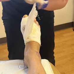 Jay S Berenter, DPM-Synergy Orthopedic Specialists Medical Group - One week post op. Changing the dressing