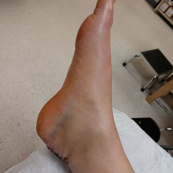 Fondren Orthopedic Group - Hopefully get out of boot today . Best of the best in Orthopedic surgery - Sports Medicine Near Me - Houston, Texas Fondren Orthopedic Group - Hopefully get out of boot today . Best of the best in Orthopedic surgery - Sports Medicine Near Me - Houston, Texas