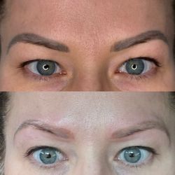 Dream Medspa - Top pic is layers of old permanent makeup Bottom pic is 60 seconds later after laser tattoo removal.