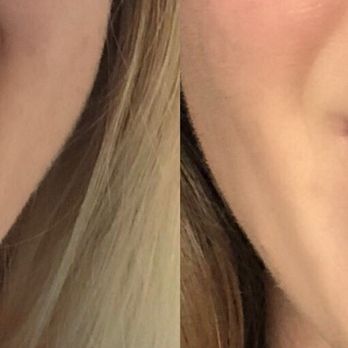 Simply Veneers - Before (left), After (right) - Cosmetic Dentists Near Me - Newport Beach, California Simply Veneers - Before (left), After (right) - Cosmetic Dentists Near Me - Newport Beach, California