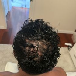 Roger Bassin, MD - After (ran out of grafts mid procedure) hardly touched the back of my head.. need the procedure again and had to WAIT AN ENTIRE YEAR!!