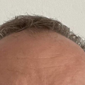 Cassia Cardoso - October 2022 - Before hair PRP treatments and the preceding FUE transplant. - Skin Care Near Me - Ft Lauderdale, Florida Cassia Cardoso - October 2022 - Before hair PRP treatments and the preceding FUE transplant. - Skin Care Near Me - Ft Lauderdale, Florida
