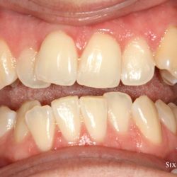 Gentle Dental Fam Dentistry - Before " 6 Month Smiles "