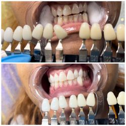 Allure Artistry Studio - Teeth whitening