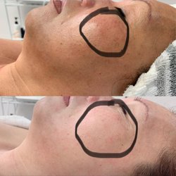 Facial DMK after one time!!