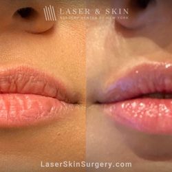 Laser & Skin - Filler Injections to Add Volume and Symmetry to Lips