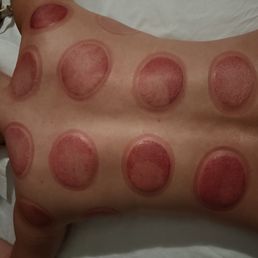 Cupping