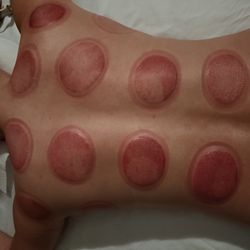 Cupping