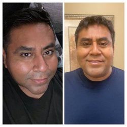 Better You Spas - After one Hifu facial and neck treatment immediately after then one more day after. Facelift, skin tightening and facial contouring.