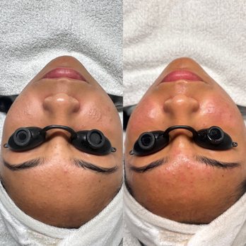LGC Esthetics - Facial before and after - Eyelash Service Near Me - Lakewood, California LGC Esthetics - Facial before and after - Eyelash Service Near Me - Lakewood, California