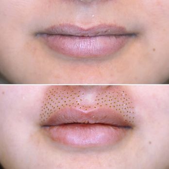 About Bodies by Shirley - Upper Lip Flip - Body Contouring Near Me About Bodies by Shirley - Upper Lip Flip - Body Contouring Near Me