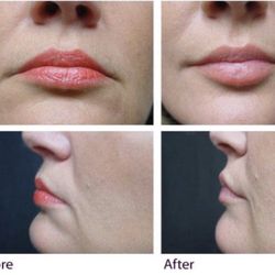 Tao Medical Spa and Wellness Center - Correct downward smile with Botox