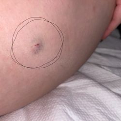 Doylestown Health - Doylestown Hospital - Bruised