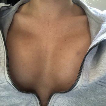 Barrett Plastic Surgery - 4 days post op, still have to drop and "fluff", but I'm so happy - Cosmetic Surgeons Near Me - Beverly Hills, California