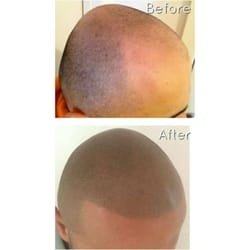 Utah Scalp Micropigmentation Center - Scalp micropigmentation, Hair replacement tattoo