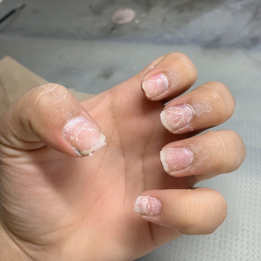 Nail Fever - Damaged nails from salons acrylic - Nail Salons Near Me - Antioch, California Nail Fever - Damaged nails from salons acrylic - Nail Salons Near Me - Antioch, California