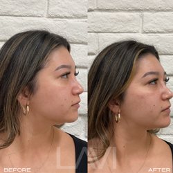 La Vi Beauty & Wellness - Refined side profile: Strategic filler placement enhances balance and adds elegance to her natural features.