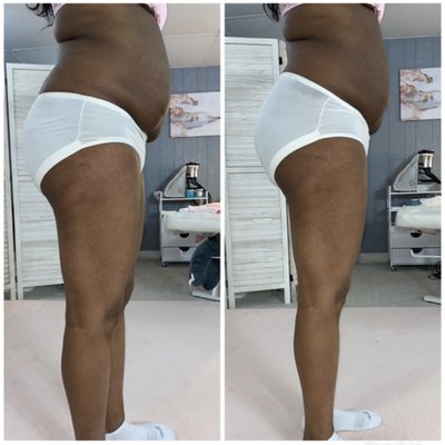 Body Contouring - Here you will find some before and afters of our body contouring services! We typically suggest booking packages to achieve optimal results. To learn more or to schedule a free consultation, please call us at (815) 295-3949 or visit our website.