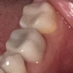2 crowns replaced, they were cracked and stained and a mess, Dr. Schmid transformed them info beautiful shiny new teeth. Bite is perfect! 2 crowns replaced, they were cracked and stained and a mess, Dr. Schmid transformed them info beautiful shiny new teeth. Bite is perfect!