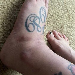 Hughston Clinic - Sprained ankle/torn ligament that SB&J in Enterprise who said nothing was wrong. Took Dr. Watson 5sec to know something wasn't right