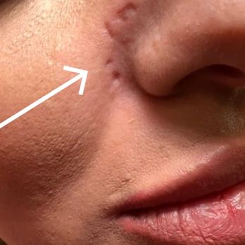 Syracuse Plastic Surgery Skin & Wellness - Permanent scars - Plastic Surgeons Near Me - Syracuse, New York
