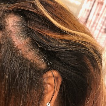 Dream Salon - My hair was freshly washed when she installed this sew in. No dandruff. After a week, this was the state of my scalp. - Hair Salons Near Me - Hyattsville, Maryland Dream Salon - My hair was freshly washed when she installed this sew in. No dandruff. After a week, this was the state of my scalp. - Hair Salons Near Me - Hyattsville, Maryland