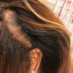 Dream Salon - My hair was freshly washed when she installed this sew in. No dandruff. After a week, this was the state of my scalp.