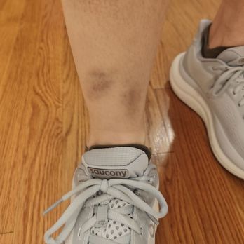 Happy Feet Spa - Bruises on leg 9 days later. - Massage Near Me - Boston, Massachusetts
