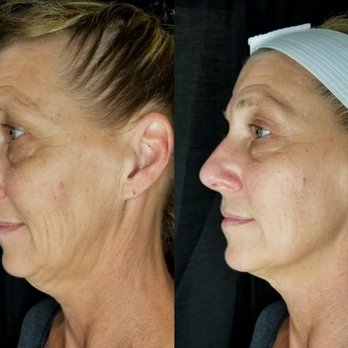 Cryo Contouring Studio - Cryotherapy Near Me - Bernardsville, New Jersey