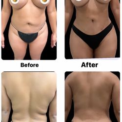 Tarzana Ambulatory Surgical Institute - Liposuction 360. 1 month post op.