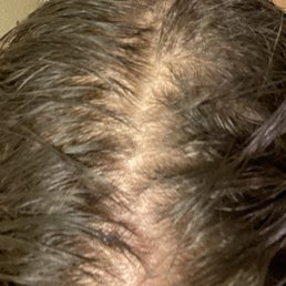 Week 1-Scalp prior to treatment