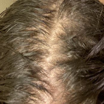 Shaheen Khosla, MD - Week 1-Scalp prior to treatment - Dermatologists Near Me - Redwood City , California