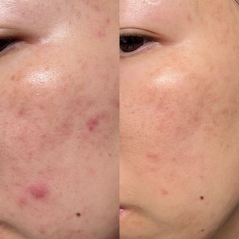 Avanti Laser Clinic - Skin Care Near Me - Fullerton, California