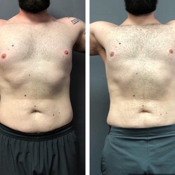 Lite Body Sculpting - Weight Loss Centers Near Me - Citrus Heights, California