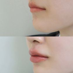 Akoya Aesthetics & Wellness - True artistry in aesthetics means enhancing your beauty, not changing it. Trust the expertise of Lina, DNP, for stunningly natural results