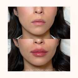 Bliss Point Medical Spa - Natural and more proportionate.