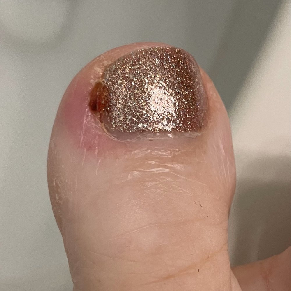 Pure Nails Spa - After almost a week of antibiotics. Still infected. - Nail Salons Near Me - Wildomar, California Pure Nails Spa - After almost a week of antibiotics. Still infected. - Nail Salons Near Me - Wildomar, California