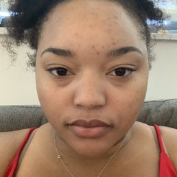 It may not look like much but I had a lot of dry patches and small pimples that are now extracted and no dry patches It may not look like much but I had a lot of dry patches and small pimples that are now extracted and no dry patches