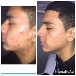 After 5 sessions of the Dermapen.